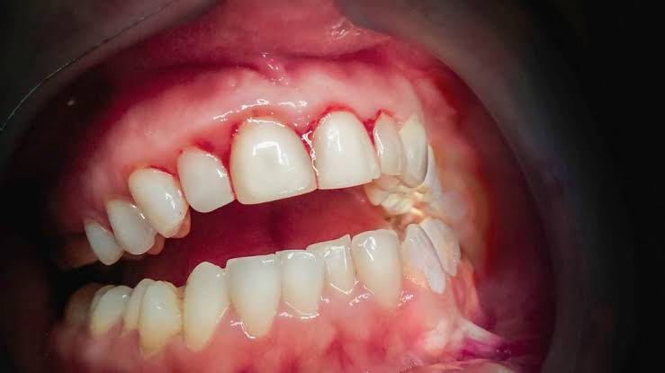 How to Prevent Gum Disease and Gingivitis: A Complete Guide